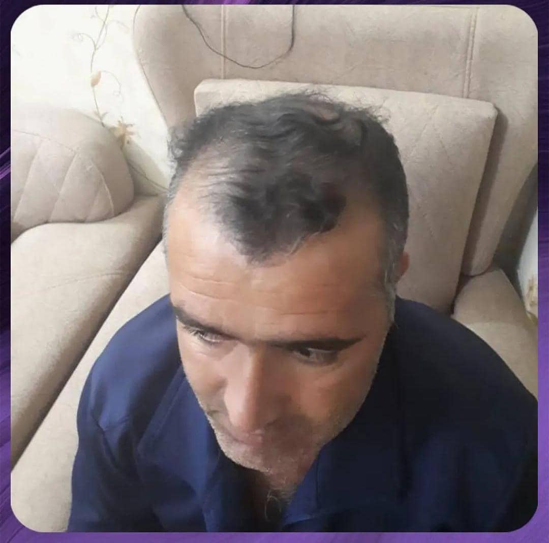 انواع روش‌های کاشت مو