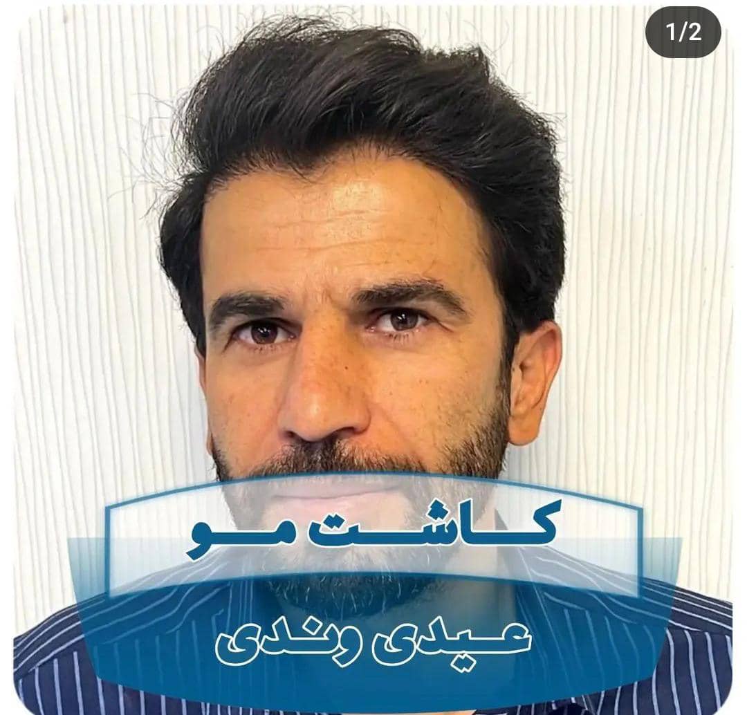 مزایای کاشت مو